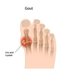 Practical Information on Gout | ADW Diabetes