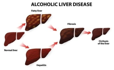 What Does Liver Disease Have to do With Diabetes? | ADW Diabetes