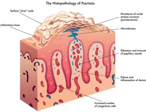 Psoriasis & Diabetes – The Most Current Information