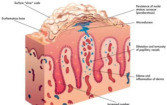 Psoriasis and Diabetes (Updated 2024)