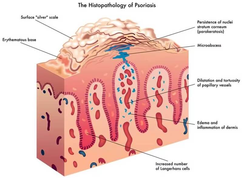 Psoriasis and Diabetes (Updated 2024)